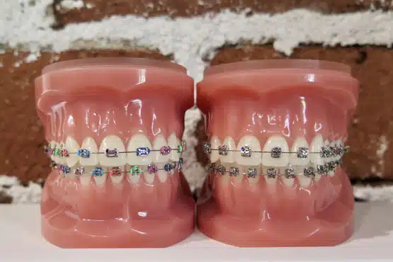 traditional metal braces
