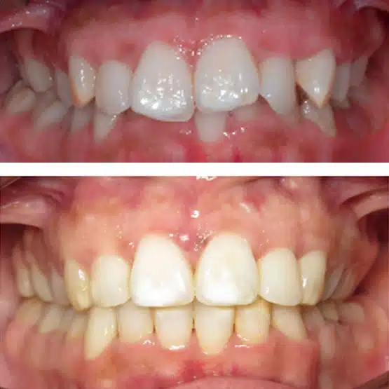 Deep Bite with Flared Teeth