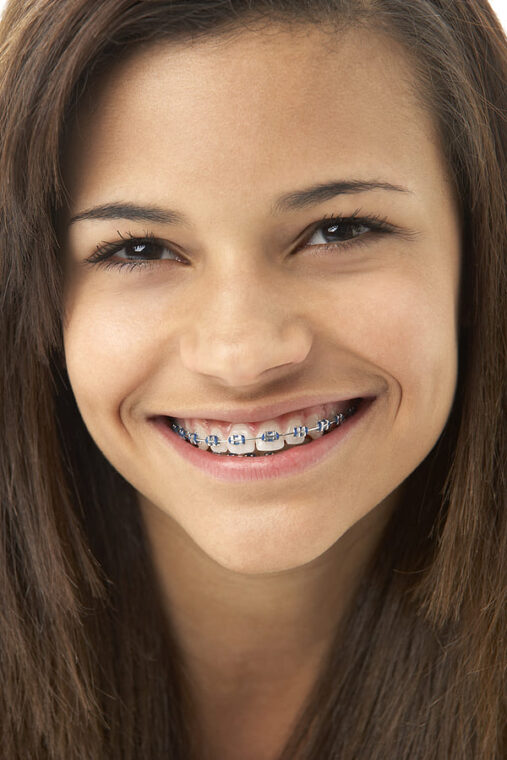 Braces Treatment in Los Angeles