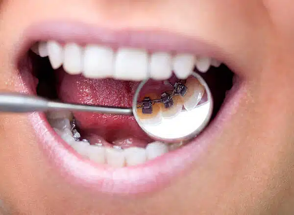 Female patient showing her invisible lingual braces braces on dental mirror