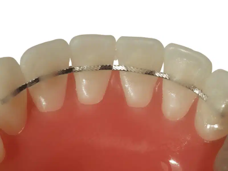 Fixed Bonded Retainers in los angeles