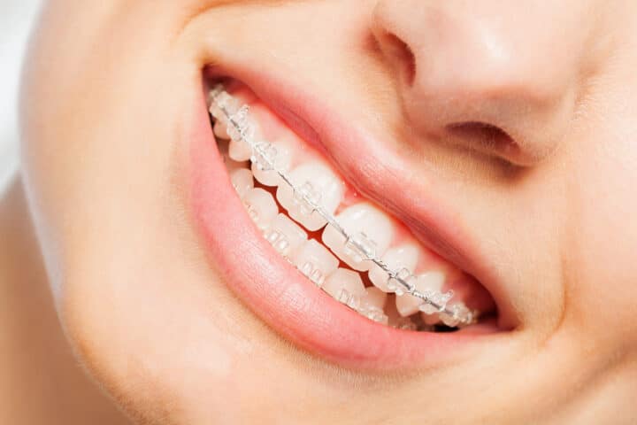 Clear ceramic braces on teeth close up