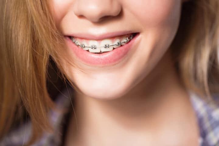 Patient smiling with traditional metal braces
