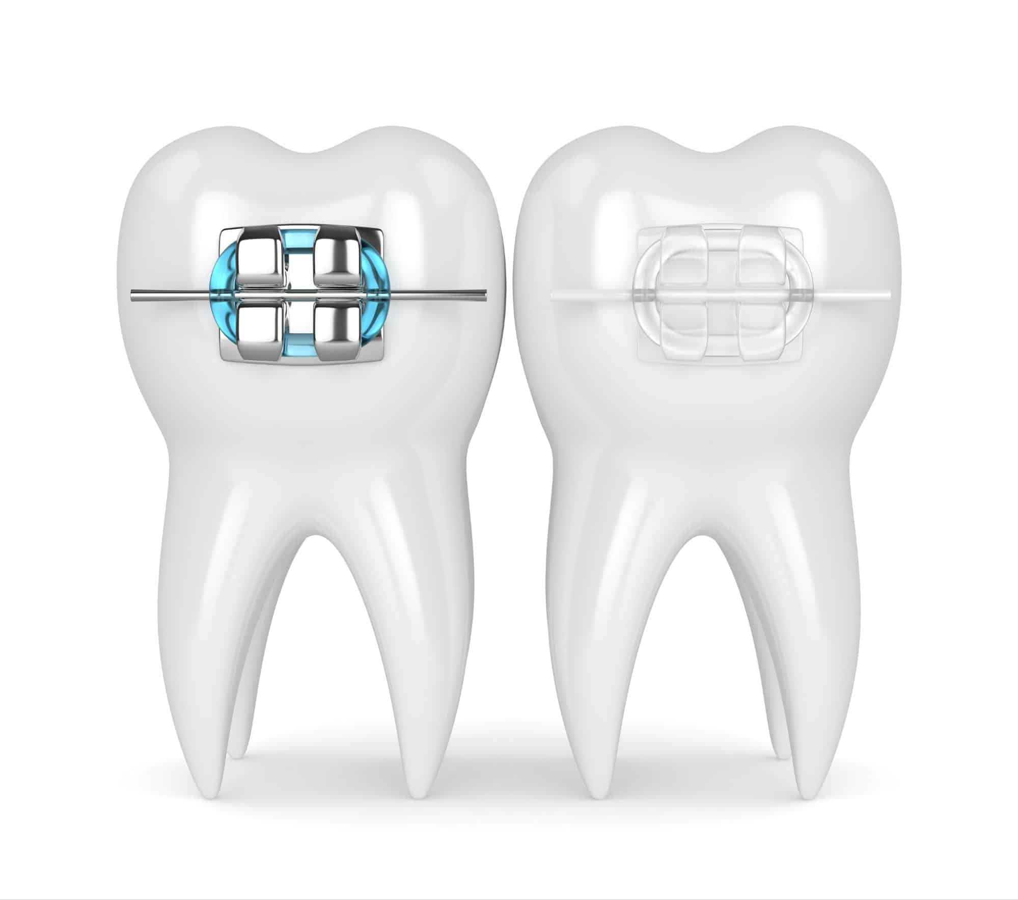 Traditional Braces vs. Clear Braces: Which Is Right for You?