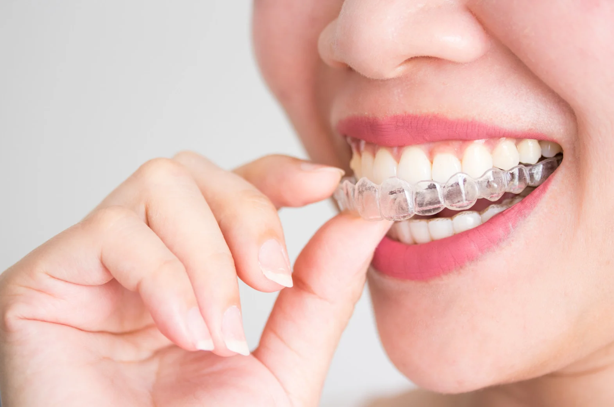 What is Invisalign for Adults?