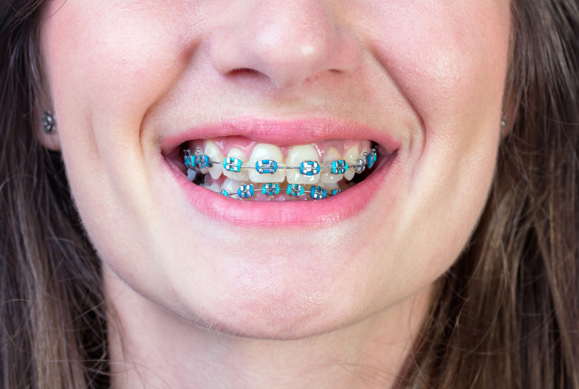 What Factors Affect the Cost of Clear Braces in LA?
