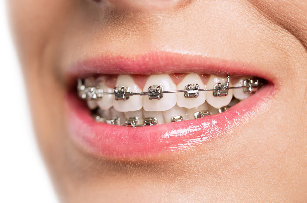 How Much Do Braces Cost in Los Angeles on average?